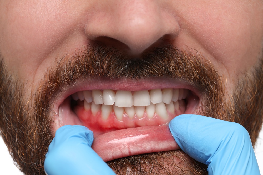 Dental provider in blue gloves examining a bearded man's inflamed, red gums