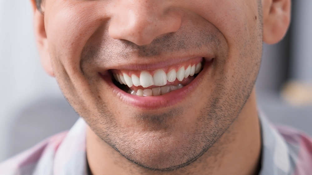 Happy perfect white teeth smile close up. American dental service clinic. Nice 30s person laugh. One fun young adult man. Joyful male guy face closeup. Oral tooth whitening stomatology. Dentistry care