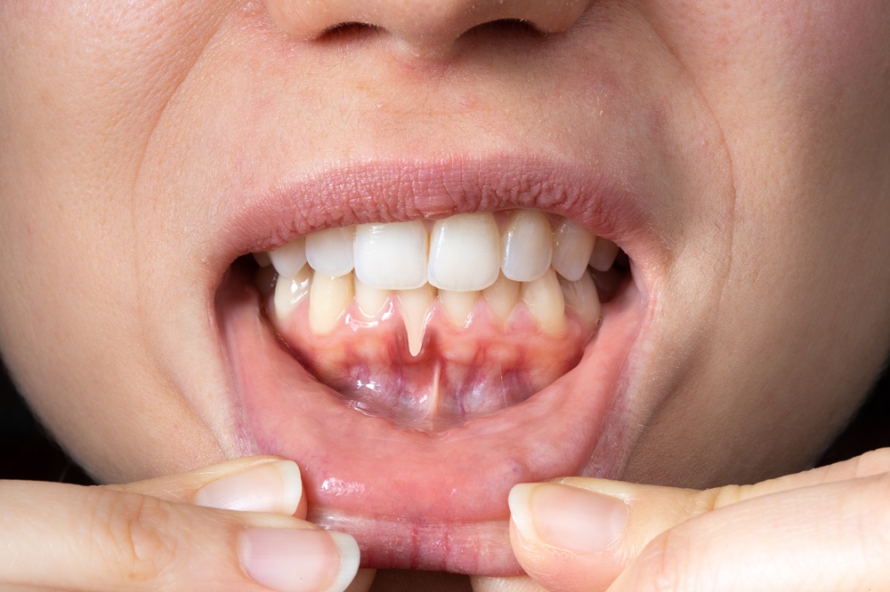 Signs of early periodontitis: gum recession Close-up of a mouth showing gum recession along the lower teeth