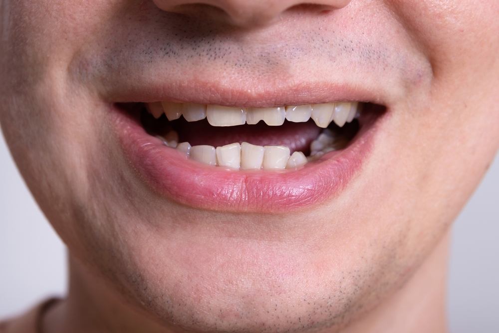 Male smile with visible chipped tooth, close up view of imperfect teeth. Concept of dental trauma, dental injury and tooth damage.