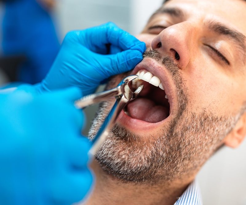 Dentist in blue gloves using forceps to extract a tooth from a patient's mouth