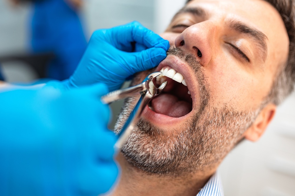 Tooth extraction procedure in Hampton Roads Dentist in blue gloves using forceps to extract a tooth from a patient's mouth
