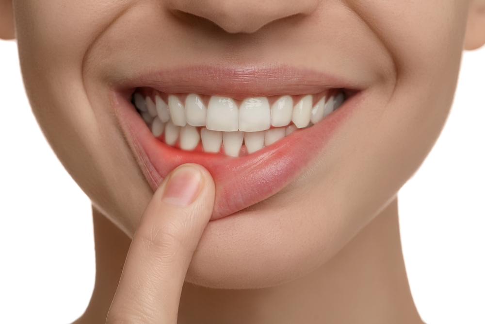Inflamed gums, an early stage of gum disease Close-up of a woman pulling down her lip to show a red, inflamed gumline
