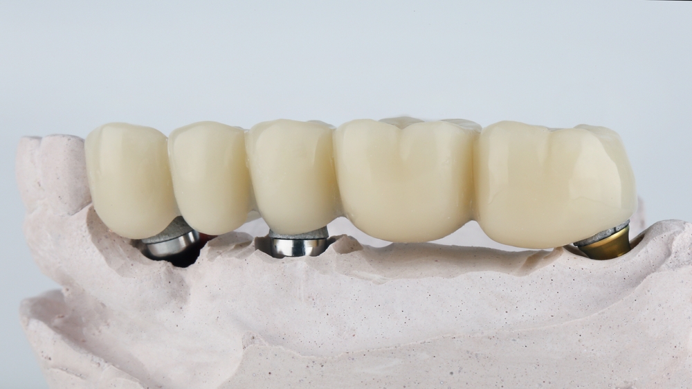 dental bridge prosthesis of five chewing teeth on a beam with a model