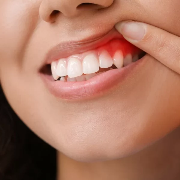 Red and swollen gums