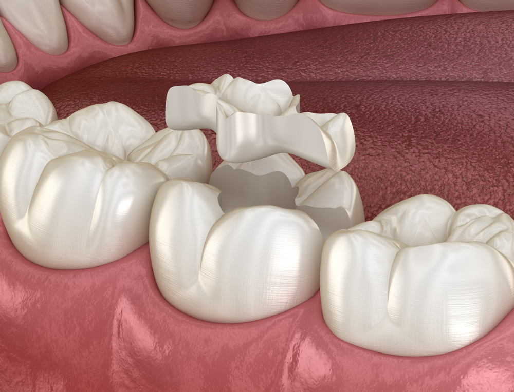 Understanding dental inlays in Virginia Beach 3D illustration of a dental inlay being placed into a molar tooth