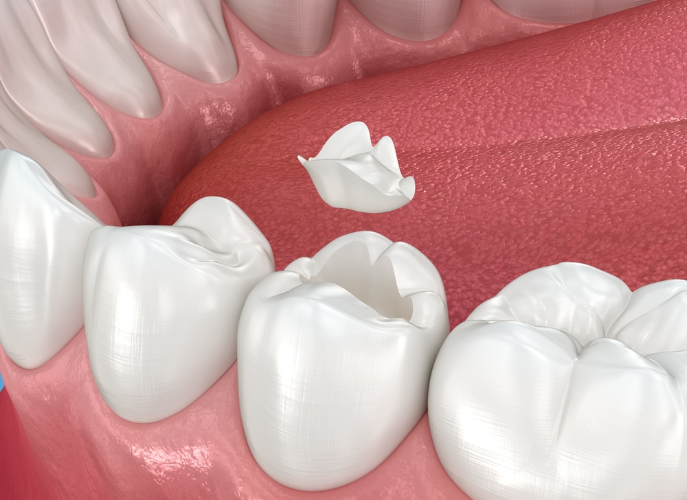 Understanding dental onlays in Hampton Roads 3D illustration of a dental onlay being placed on a molar tooth