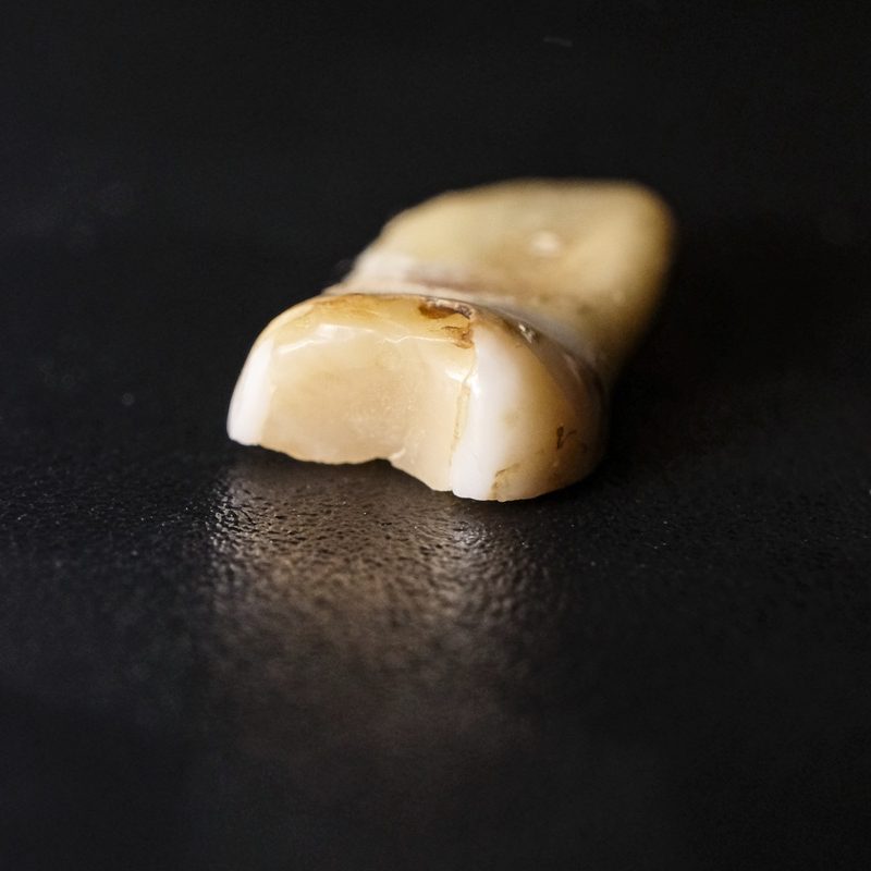 Close-up of an extracted tooth on a dark surface showing visible decay