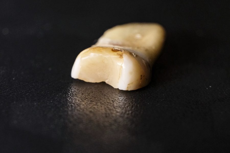 Close-up of an extracted tooth on a dark surface showing visible decay