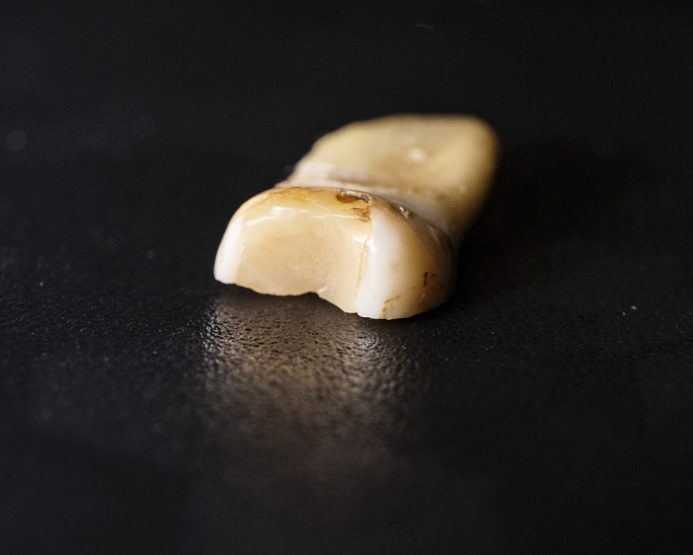Close-up of an extracted tooth on a dark surface showing visible decay