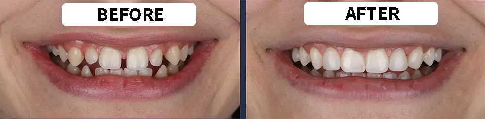 Before and after photos showing straighter, more even teeth after dental bonding 